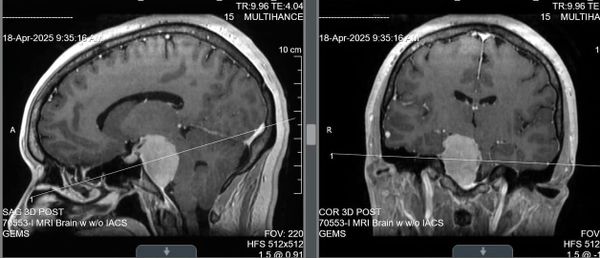 Welcome to My Mind... and My Meningioma*