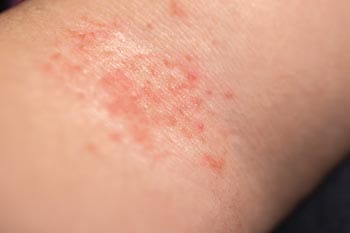 Rash on arm