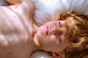 Child with chickenpox