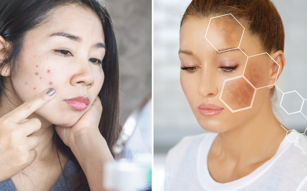 Can Centella Asiatica Remove Dark Spots? Exploring Its Skin-Clearing Potential