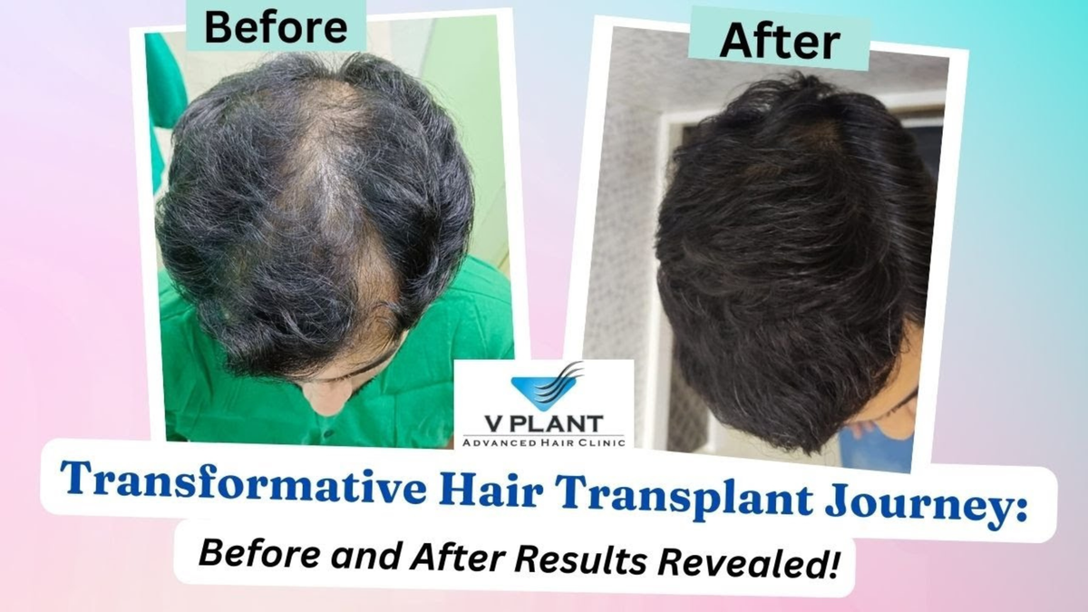 Vplant Hair Clinic Mumbai Introduces Advanced MHI Hair Transplant Technique for Painless, Scar-Free Results