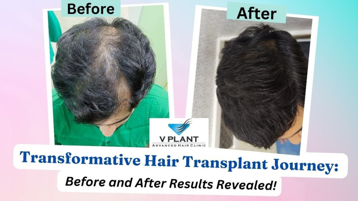 Vplant Hair Clinic Mumbai Introduces Advanced MHI Hair Transplant Technique for Painless, Scar-Free Results