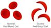 Sickle Cell Awareness Month — Part III: Treatment Available in Columbus