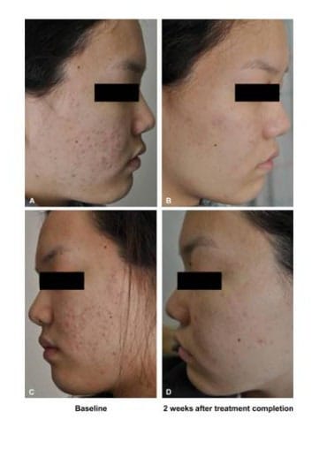 Acne Treatment with PDT: Side Effects, Chlorophyll PDT Explained, and PhotoQ PDT — 2