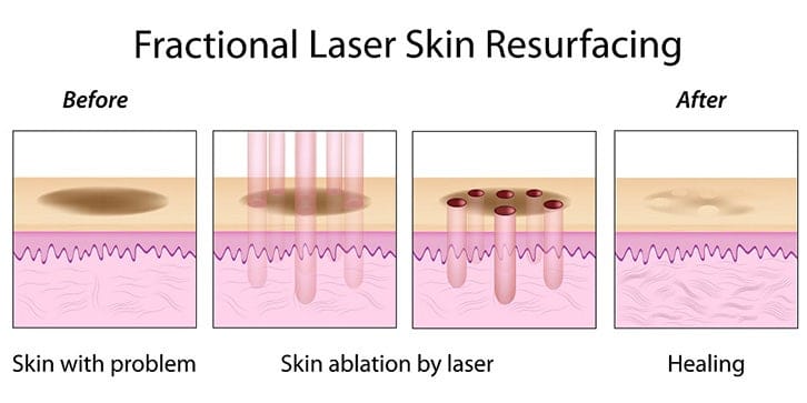 Pores & Acne Scar Treatment: Fraxel, Palomar Starlux XD, and Icon XD Laser