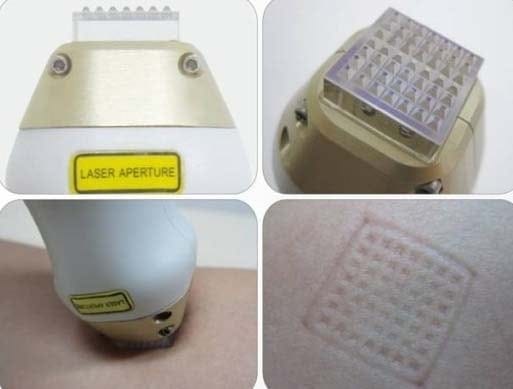 Pores & Acne Scar Treatment: Fraxel, Palomar Starlux XD, and Icon XD Laser — 4