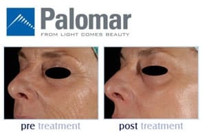 Pores & Acne Scar Treatment: Fraxel, Palomar Starlux XD, and Icon XD Laser — 5