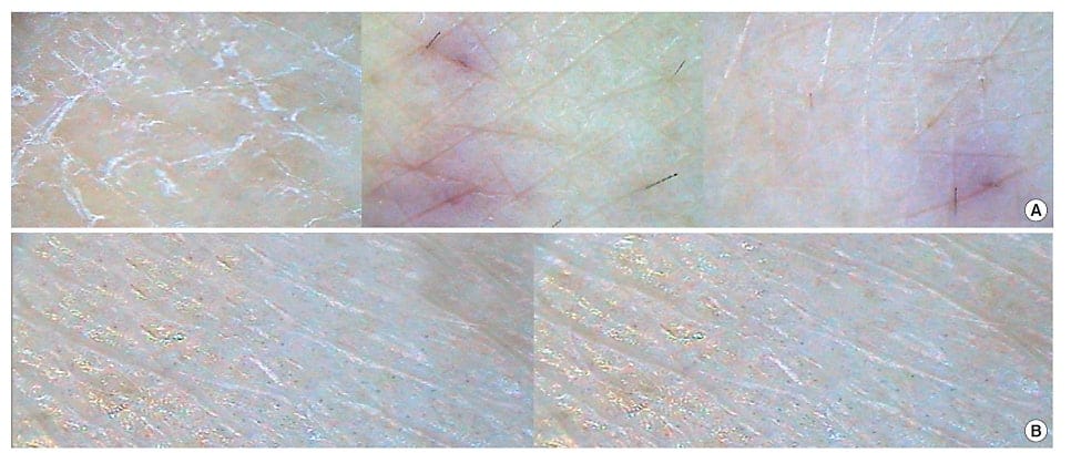 Struggling with Dry Skin? What You Should Know About Hyaluronic Acid Injections — 3