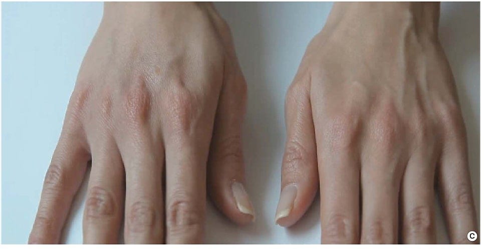 Struggling with Dry Skin? What You Should Know About Hyaluronic Acid Injections — 4