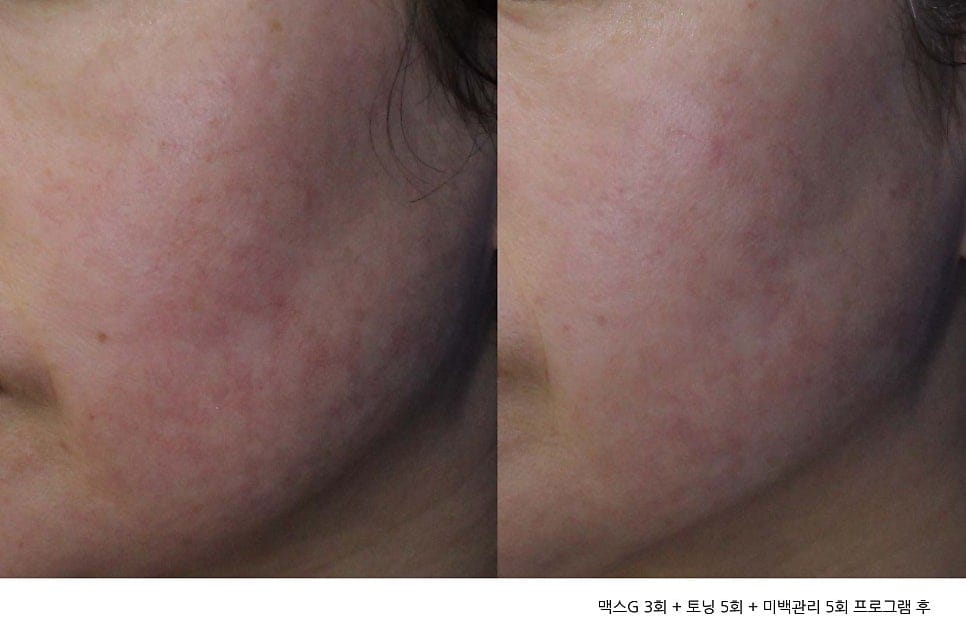 IPL, Light Absorption, and MaxG (Palomar) — Explained by Day One Clinic Gangnam — 2