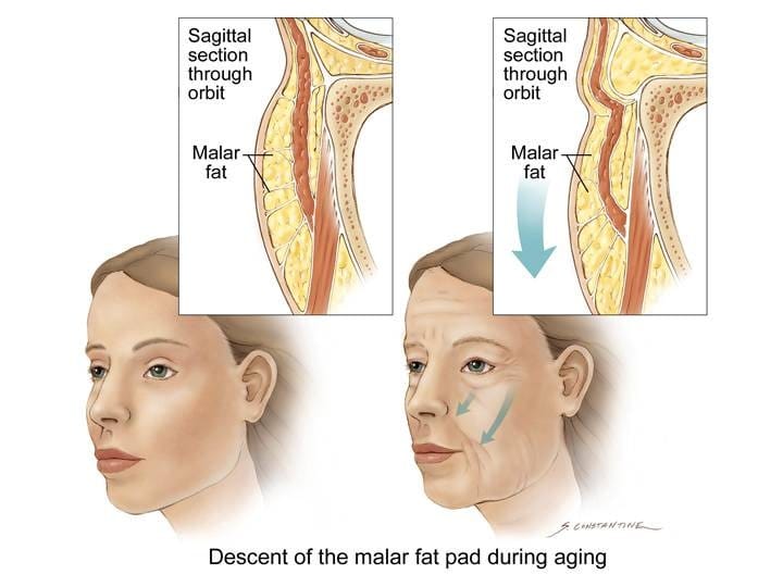 Why Skin Ages and How Lifting Treatments Work — 3