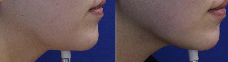 Placenta Injection (Laennec/Melsmon), Neutera HIFU Lifting, and Glutathione IV — A Doctor's Personal Treatment Diary (Jan 23, 2017)
