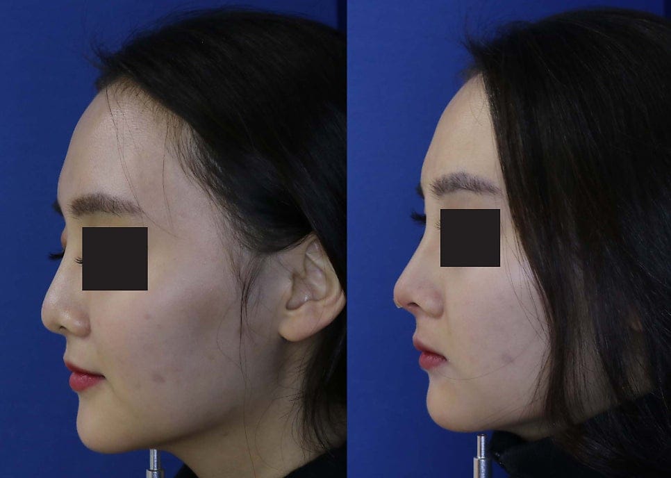 Barbie Tip & Nose Filler: Before and After Staff Photos