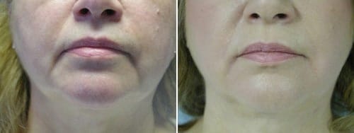 Corner of Mouth Botox and Apogee Laser Hair Removal: A Doctor's Self-Treatment