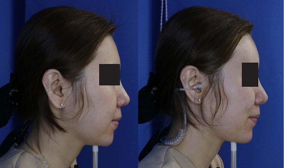 Forehead Filler Before and After: Real Results with Belotero
