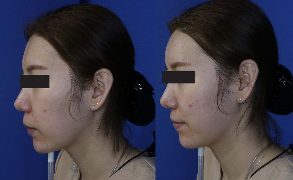 Forehead Filler Before and After: Real Results with Belotero — 2