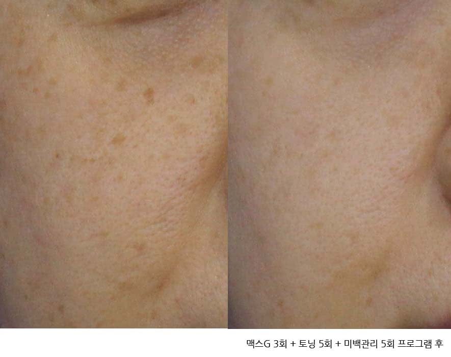 IPL, Light Absorption, and MaxG (Palomar) — Explained by Day One Clinic Gangnam