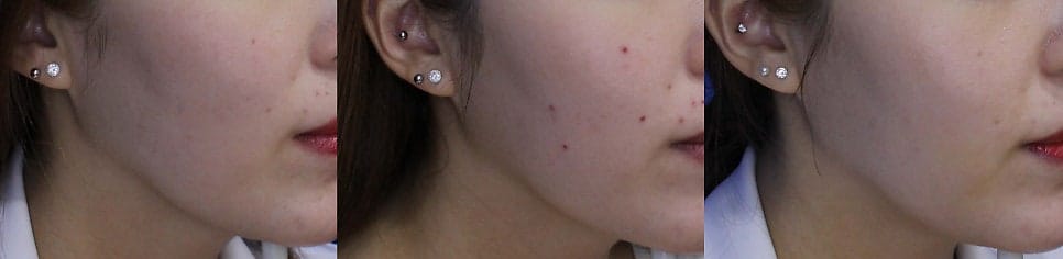 Ruby Laser Treatment Experience: Before & After Results — 2