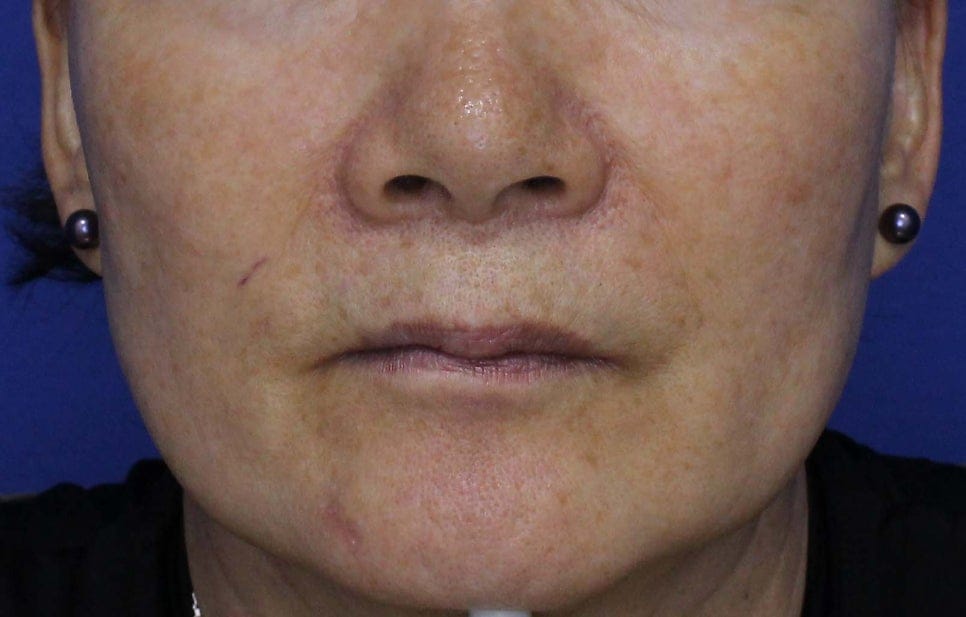 Vascular Treatment with MaxG: Before & After Photos and Review — 2