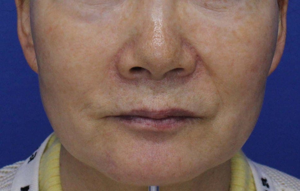 Vascular Treatment with MaxG: Before & After Photos and Review — 3