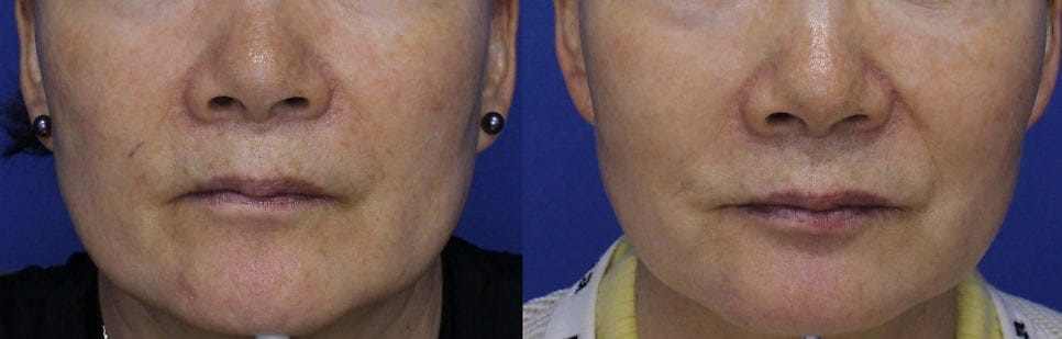 Vascular Treatment with MaxG: Before & After Photos and Review — 4