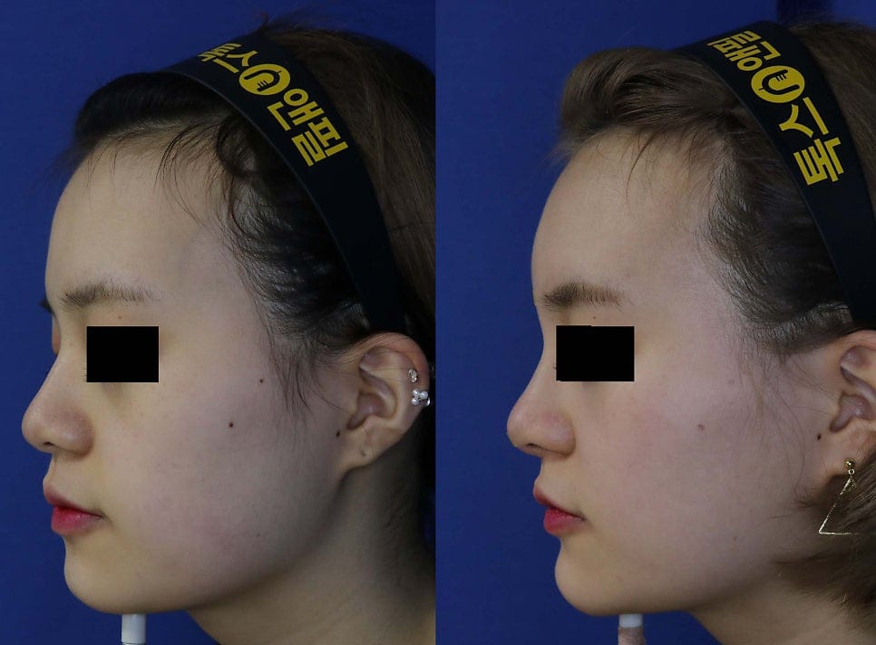 Full-Face Filler Before & After: Forehead, Nose, and Chin Filler Results
