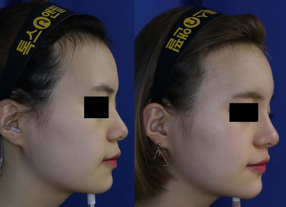 Full-Face Filler Before & After: Forehead, Nose, and Chin Filler Results — 2