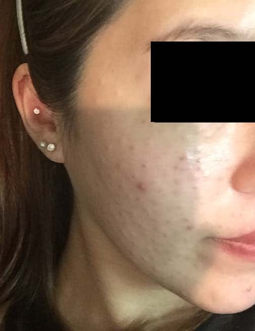 Rejuran Healer 2nd Session (2cc) – An Honest Personal Review