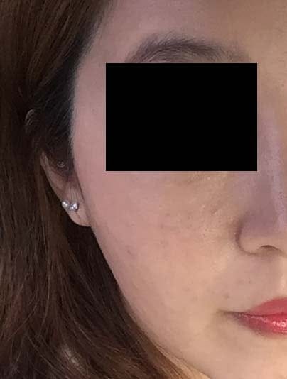 Rejuran Healer 2nd Session (2cc) – An Honest Personal Review — 2