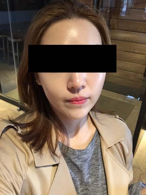 Rejuran Healer 2nd Session (2cc) – An Honest Personal Review — 3
