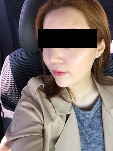 Rejuran Healer 2nd Session (2cc) – An Honest Personal Review — 4