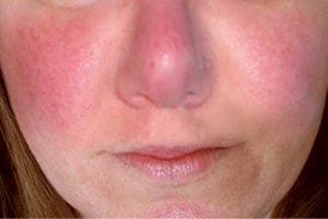Treating Facial Redness Part 1: Flushing vs. Rosacea