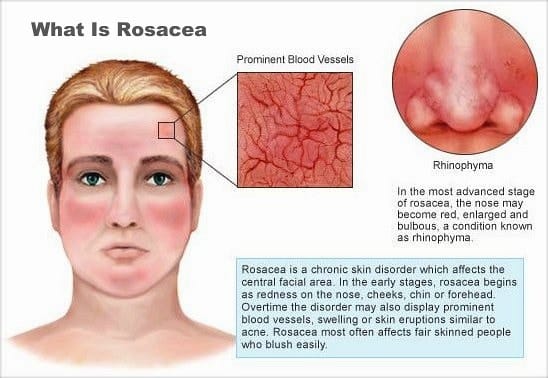 Treating Facial Redness Part 1: Flushing vs. Rosacea — 2