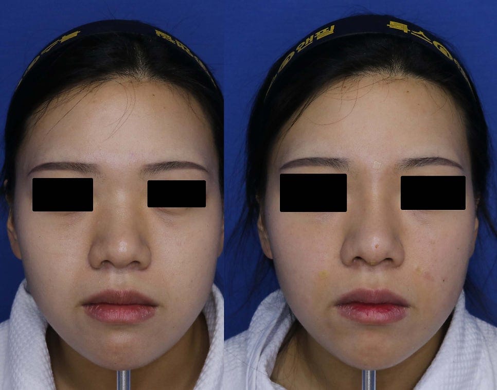 Barbie Nose (Barbiko) & Nose Filler Before and After Photos