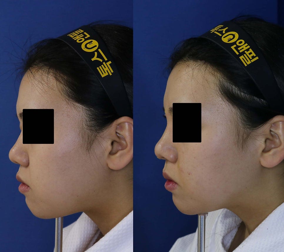 Barbie Nose (Barbiko) & Nose Filler Before and After Photos — 2