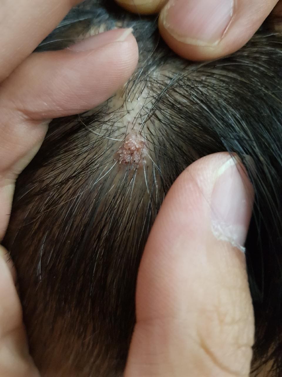 Filiform Warts: What They Are and How They Are Treated