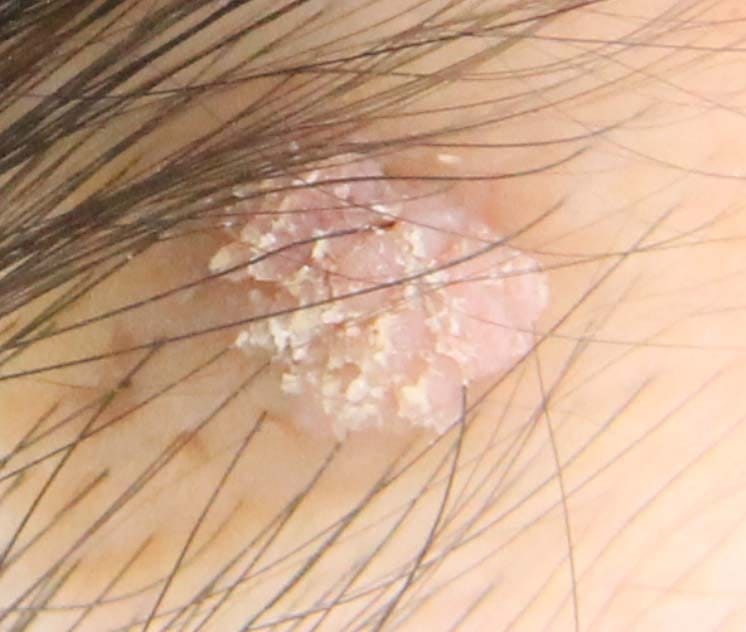Filiform Warts: What They Are and How They Are Treated — 2