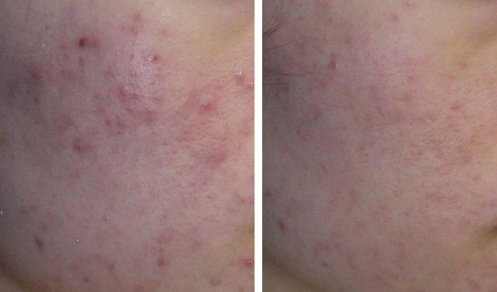 Acne Treatment Before and After Photos