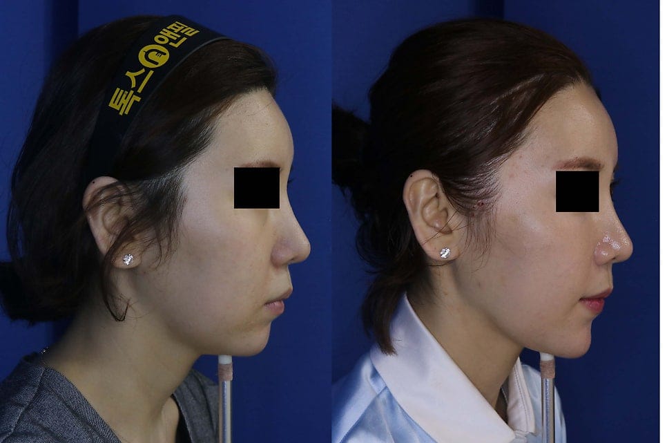 Air Jet Lifting Before & After Photos – Results and Review — 2