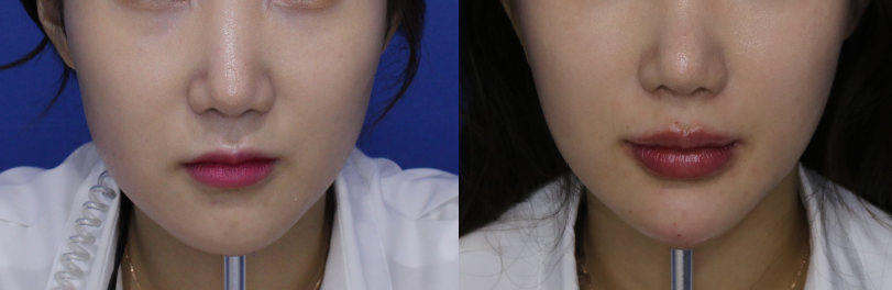 Air Jet Lifting Before & After Photos – Results and Review — 3