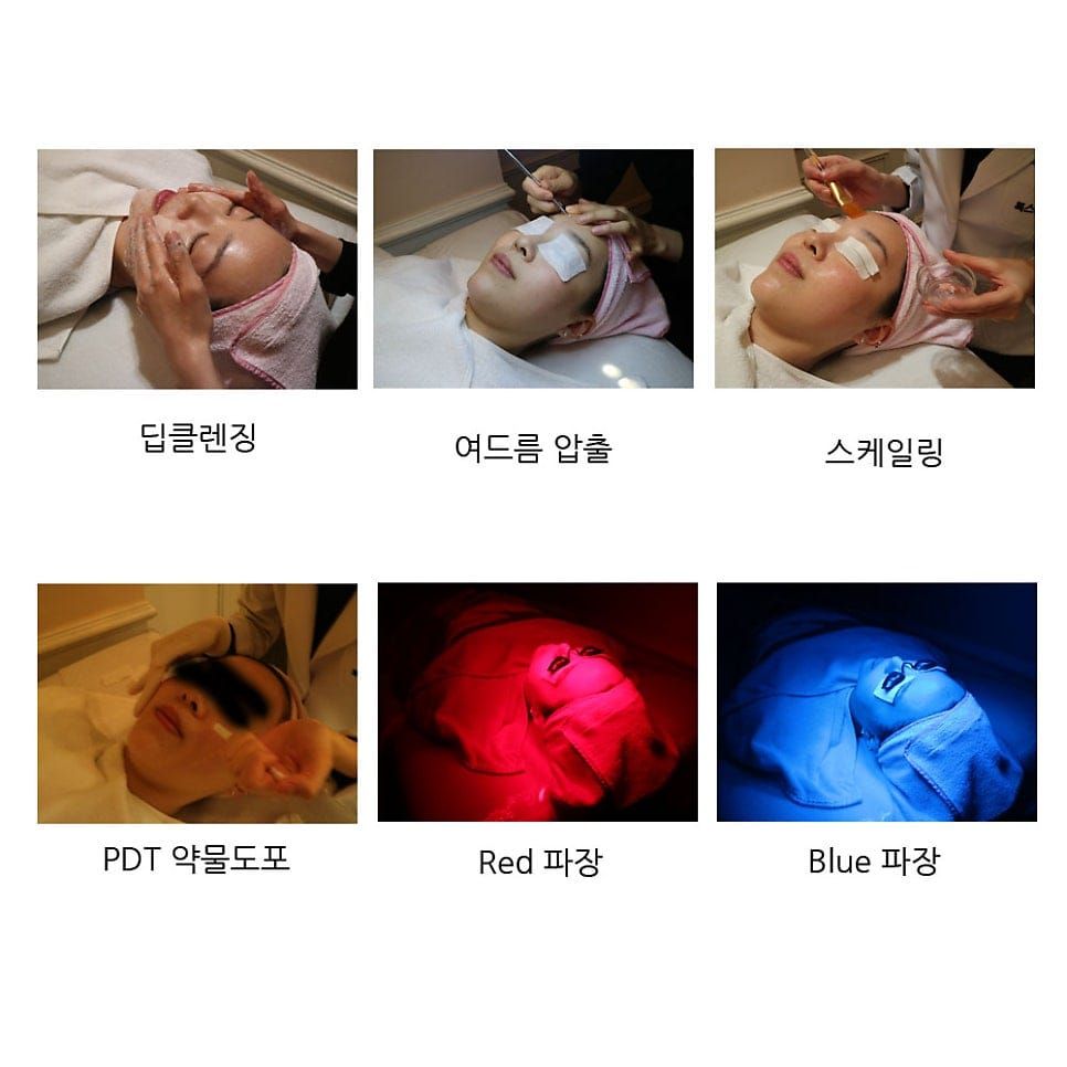Acne Treatment – PDT (Photodynamic Therapy) Program
