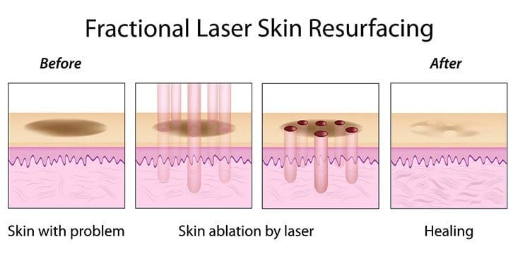 Pores & Acne Scar Treatment: Fraxel, Palomar Starlux XD, and Icon XD Laser