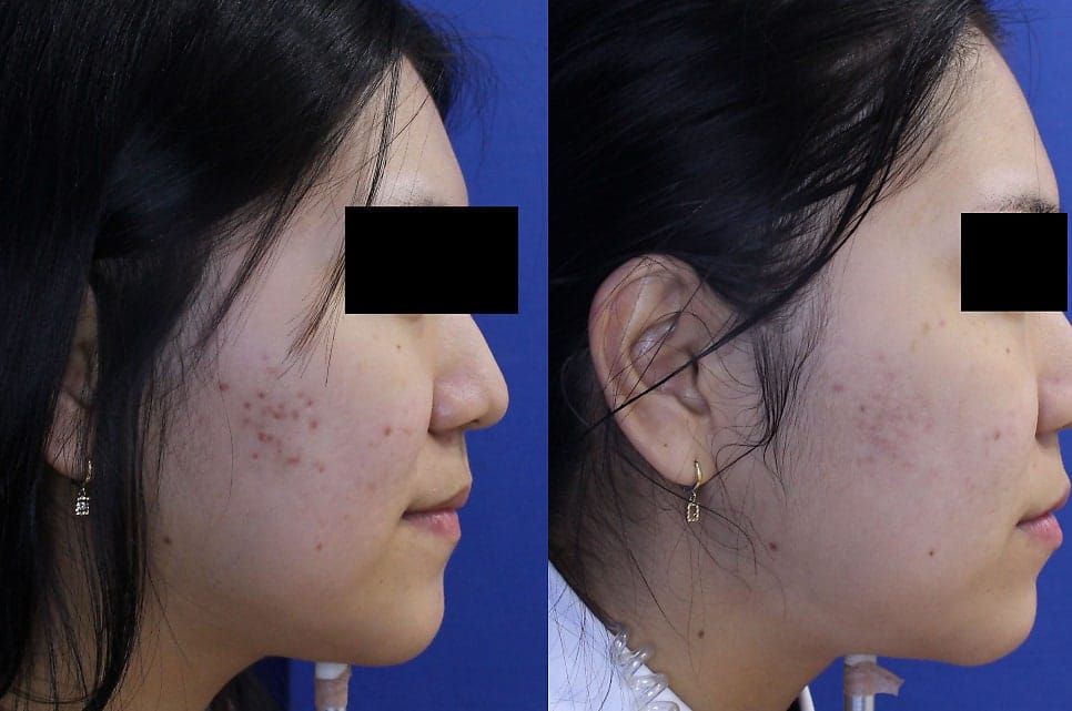 Rejuran Scar Treatment: Before and After Photos After 1 Session