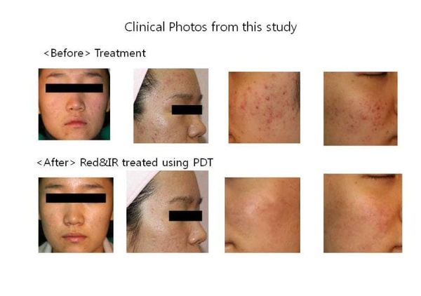 Acne Treatment with PDT: Side Effects, Chlorophyll PDT Explained, and PhotoQ PDT
