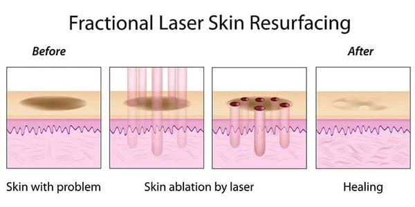 Pores & Acne Scar Treatment: Fraxel, Palomar Starlux XD, and Icon XD Laser
