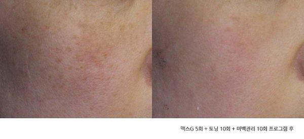 IPL, Light Absorption, and MaxG (Palomar) — Explained by Day One Clinic Gangnam