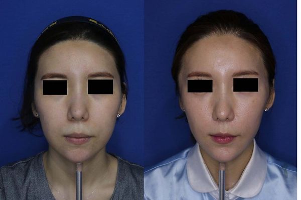 Air Jet Lifting Before & After Photos – Results and Review