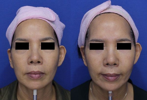 1 Year of Consistent Skin Care for Mom: HIFU Lifting, Air Jet Lifting & Rejuran Before and After