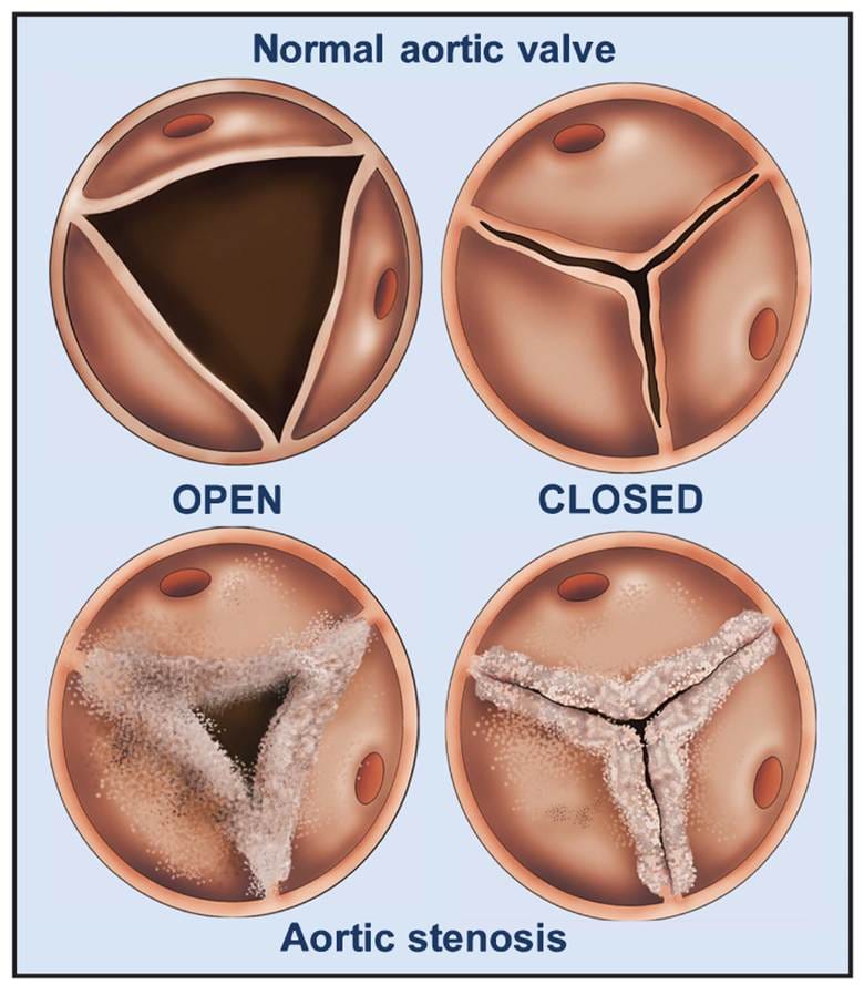 Normal heart valve vs Aortic stenosis