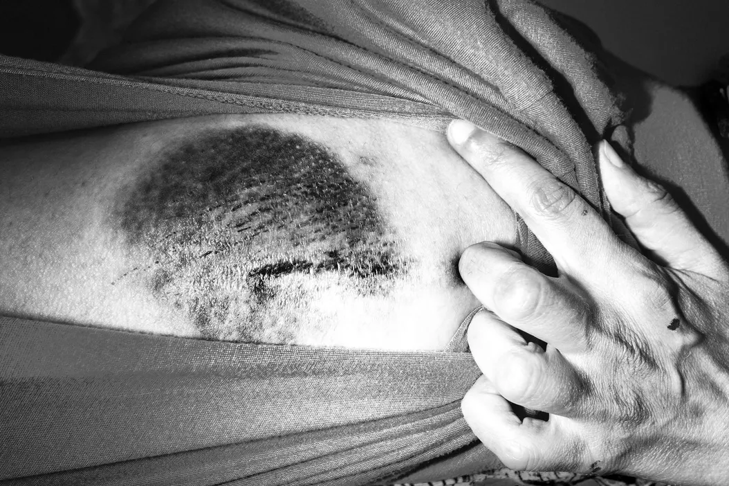 Bone cutter. Skull clamp. Buzz saw.